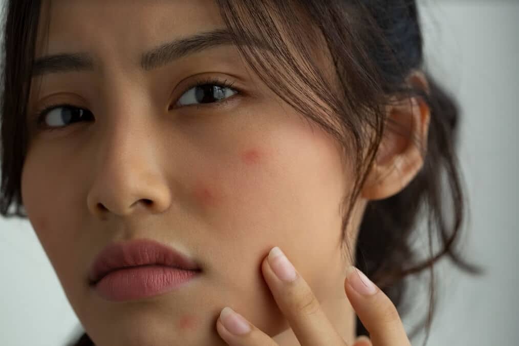 痘痘爆發遮不住?超好用校色遮瑕技巧,還你完美陶瓷肌! 叮咚News|分享新奇與樂趣