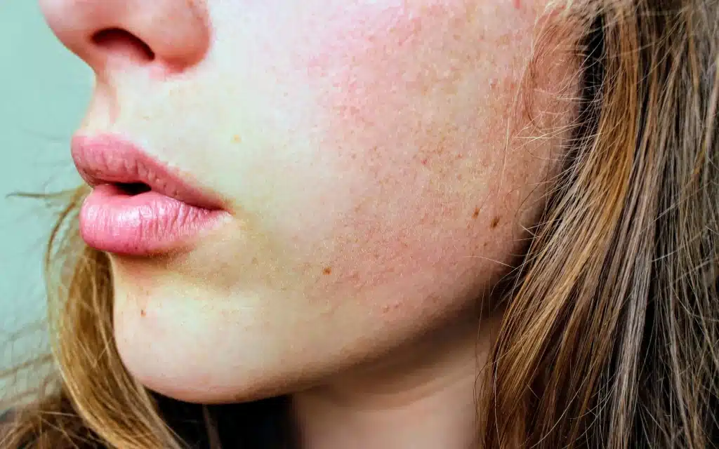 敏感性肌膚如何保養?破除迷思與3大NG行為 敏感性肌膚該如何保養?