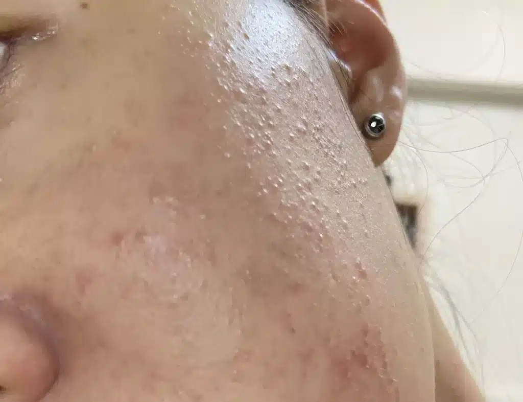 彩妝痘