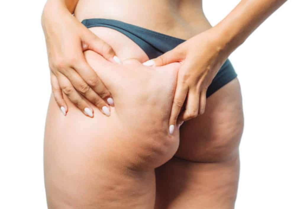 大腿、肚子的橘皮好醜好困擾怎麼辦?5招消除橘皮好方法,重拾平滑肌膚! 橘皮是什麼