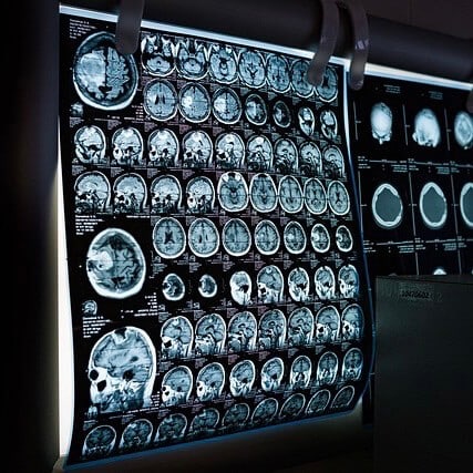 時常忽略頭痛警訊?健檢多做一樣【腦部磁振造影MRI】健康不煩「腦」! 哪些人特別需要做MRI?-3