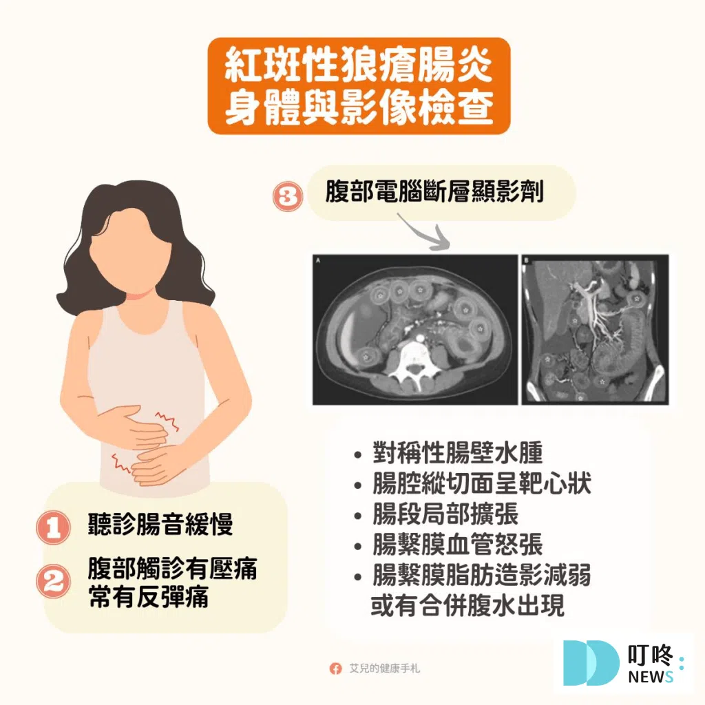 Ｑ7：紅斑狼瘡腸炎是什麼？嚴重急症？-2